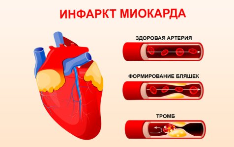 Инфаркт миокарда.jpg