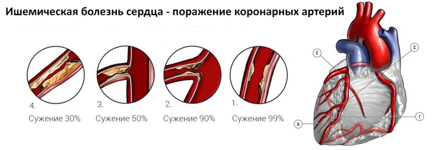 Ишемическая болезнь сердца.jpg