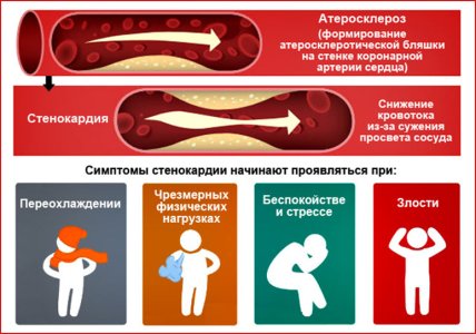 Стенокардия.jpg