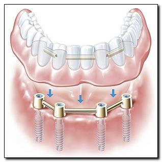 Ankylos_implantat_4-in_one-border.jpg