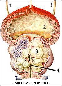 prostata_adenoma2.jpg