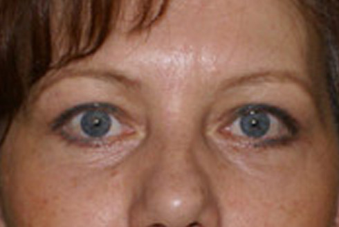 blefaroplastika-4p.jpg