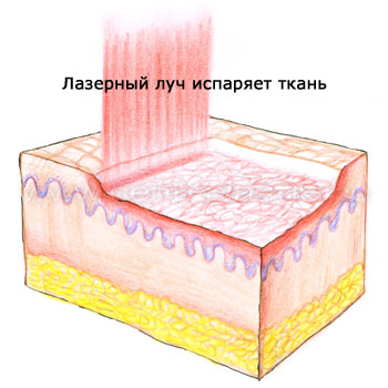 lazer_s0704.jpg