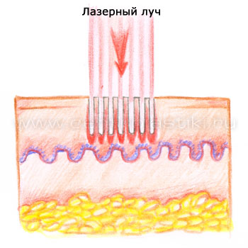 lazer_s0703.jpg