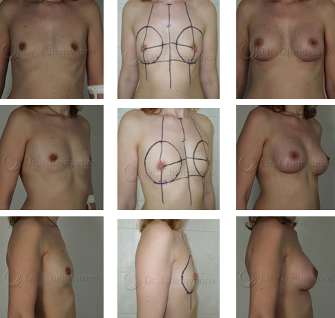Dr_Chemyanov_breast_augment.jpg