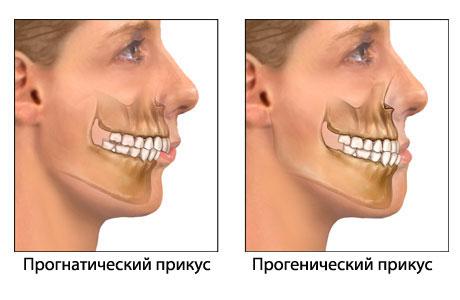 anomal-prikus-2.jpg