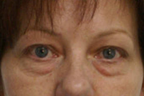blefaroplastika-4d.jpg